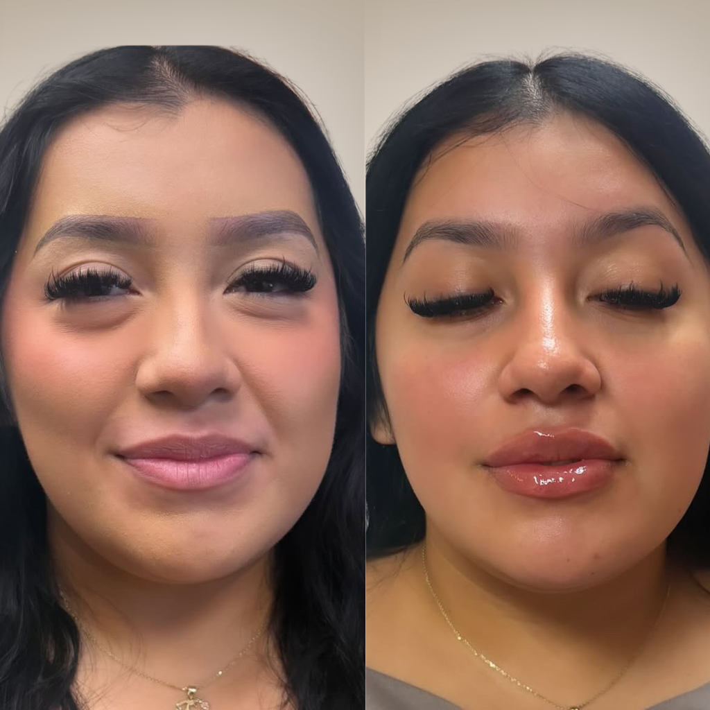 before-and-after-lip-filler-subtle-front-profile.png