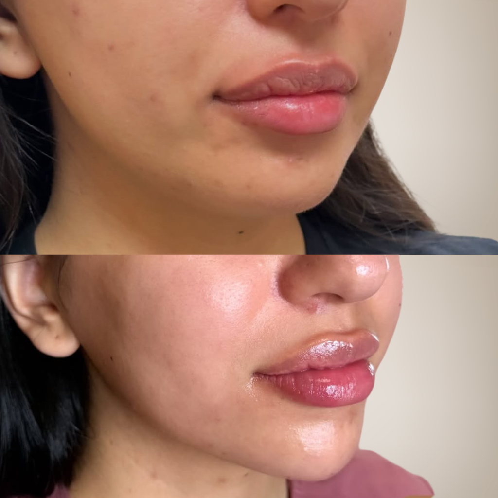 before-and-after-lip-filler-after-dissolving.png