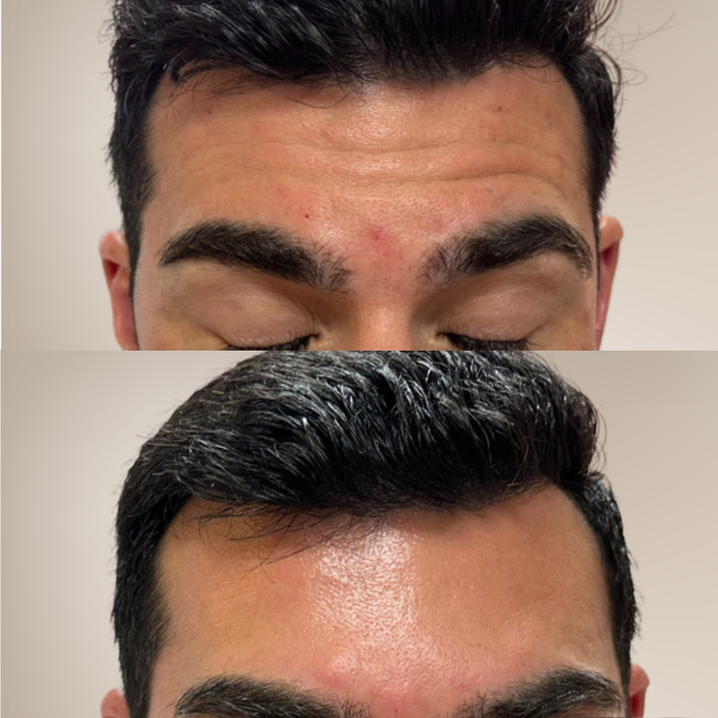 before-and-after-male-forehead-botox-close-up-profile.png