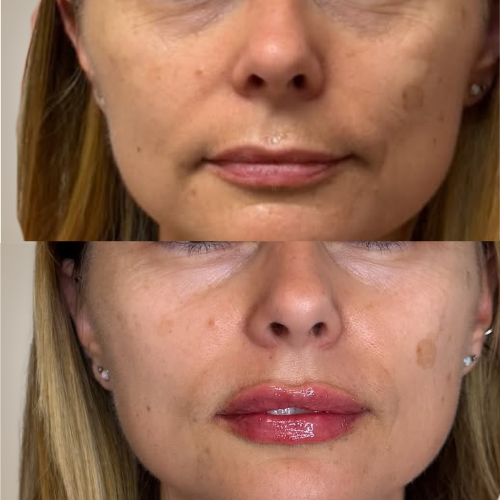 before-and-after-close-up-lip-filler-for-thin-lips-front-profile.png