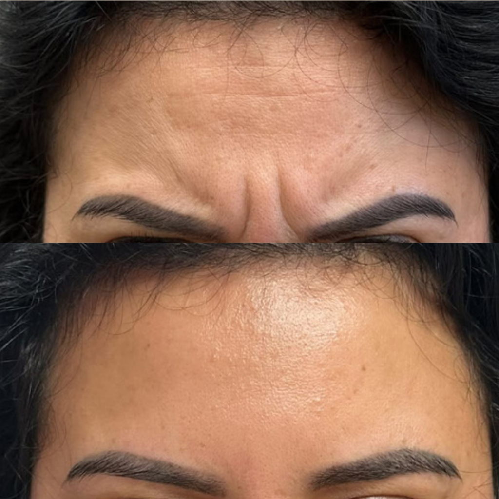 before-and-after-close-up-botox-glabellar-and-forehead-lines.png