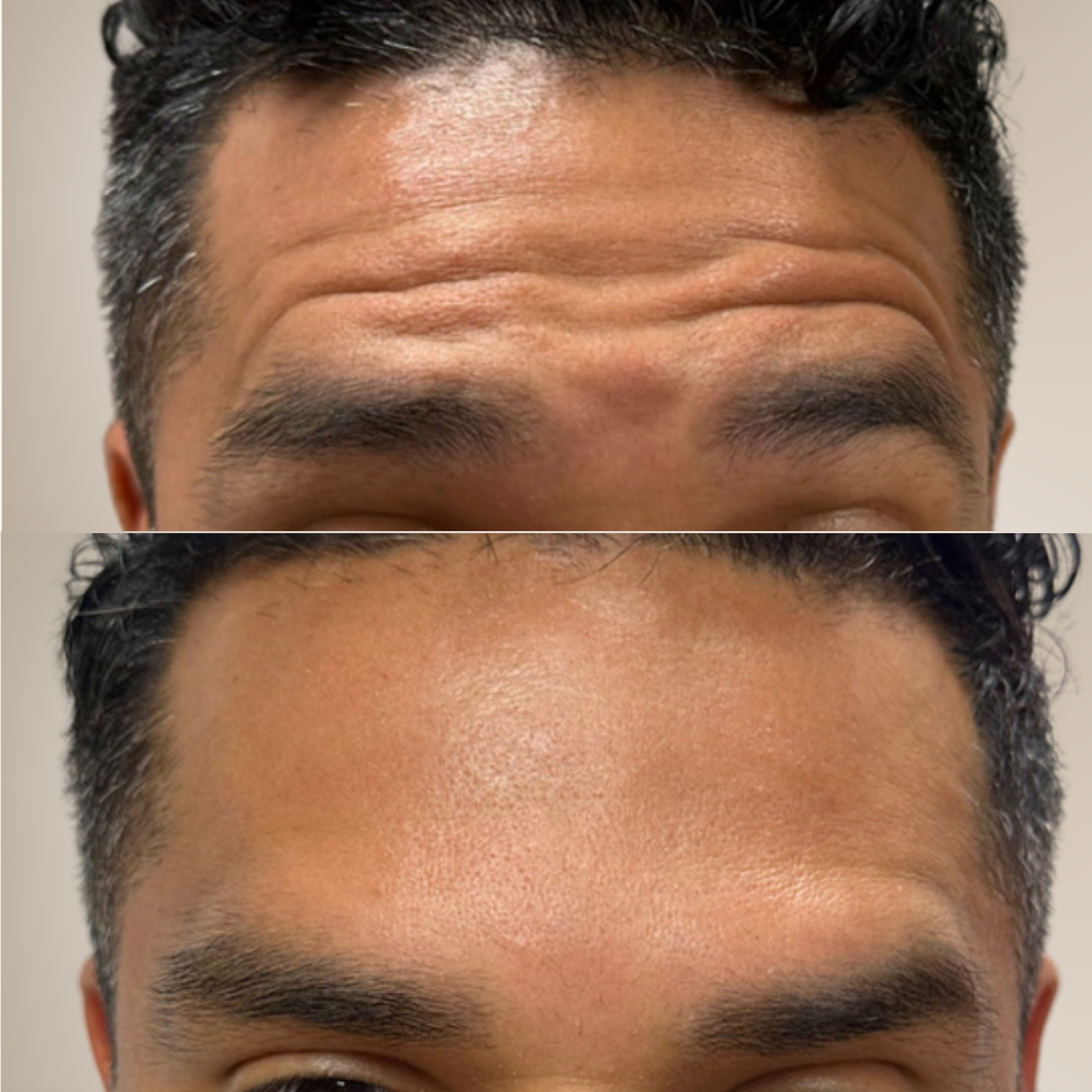 before-and-after-male-forehead-close-up-botox.png