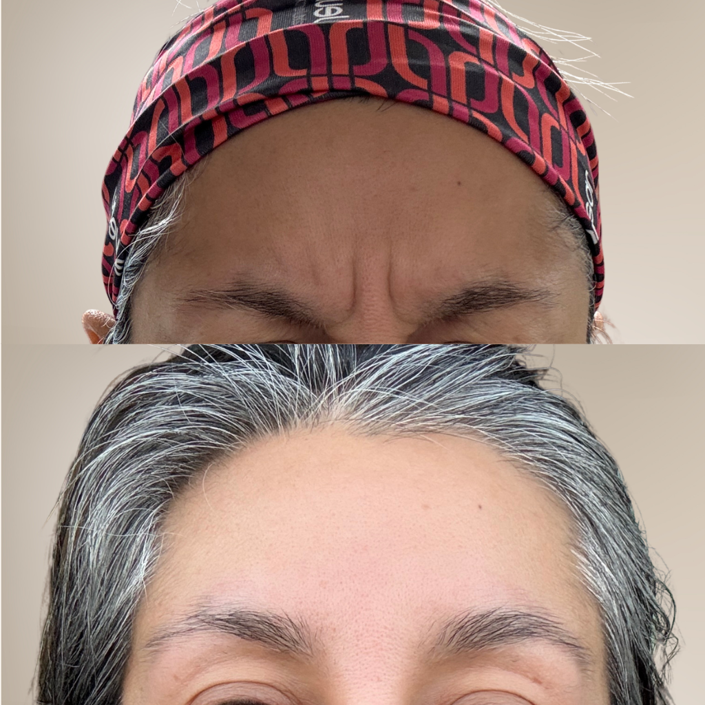 before-and-after-glabellar-wrinkles-forehead-close-up.png