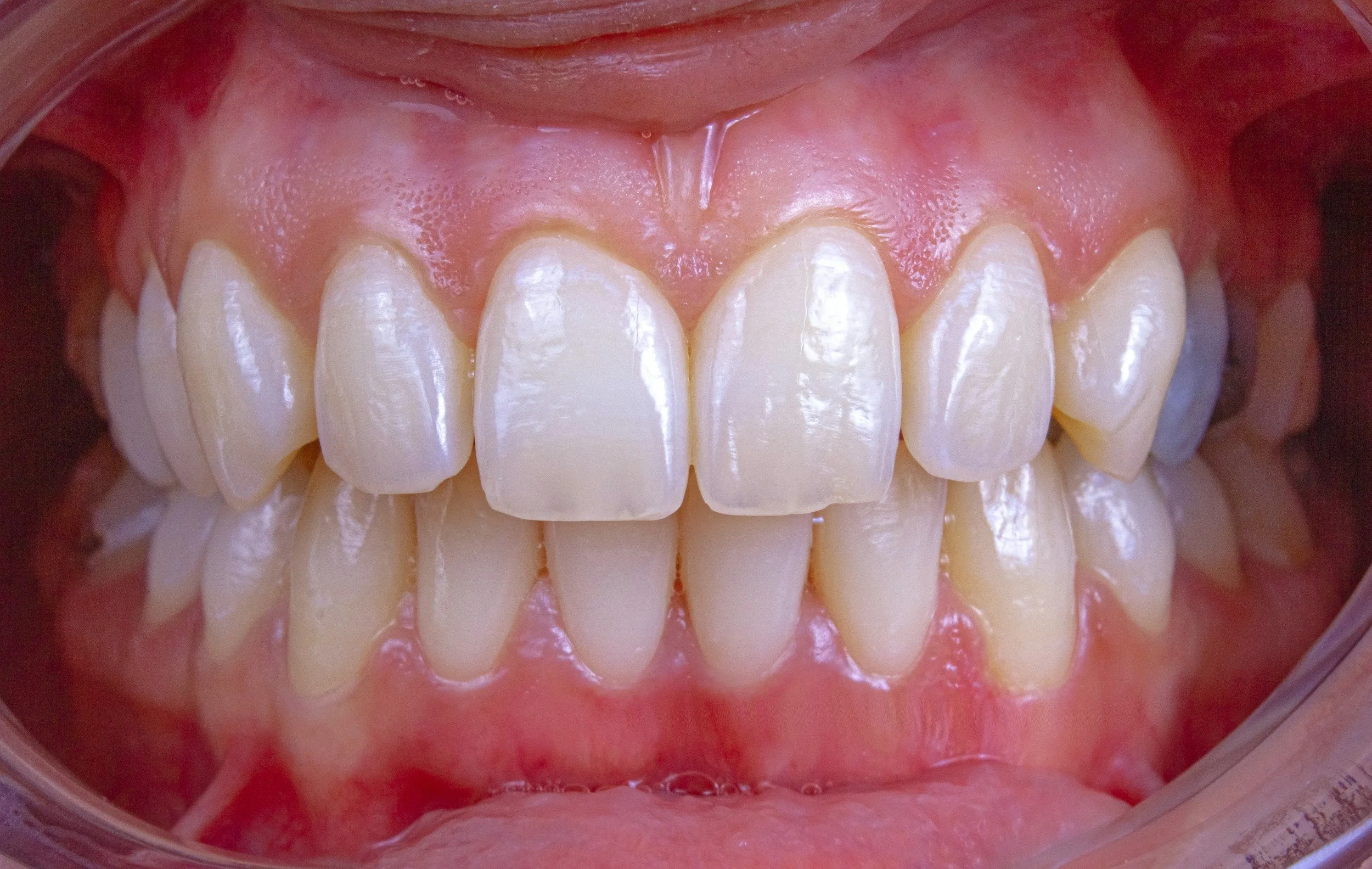 Close-up of upper and lower front teeth with pink gums, showing dental cleanings or examination.