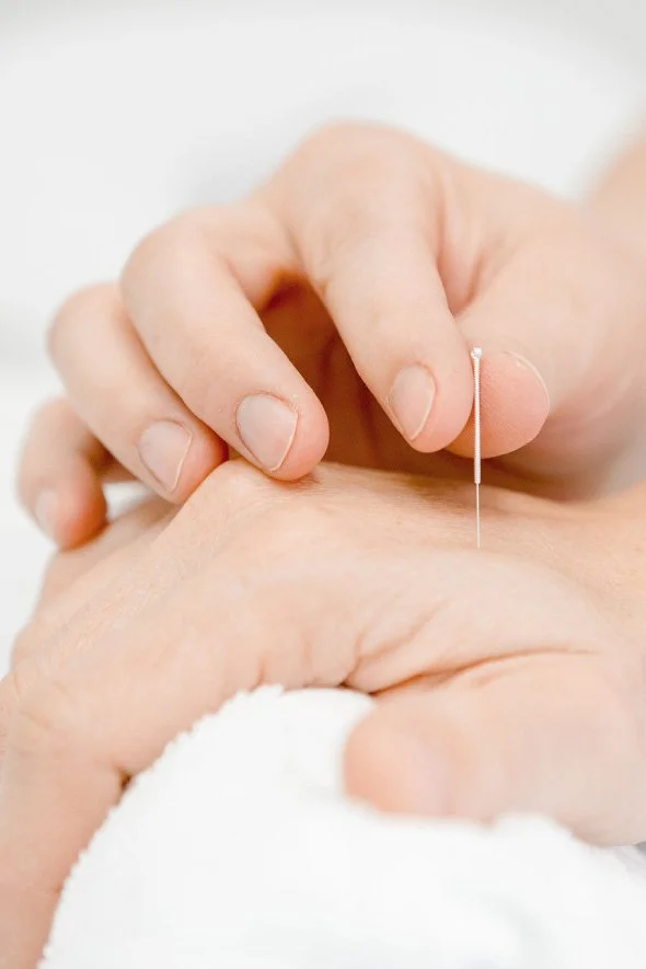 Acupuncture