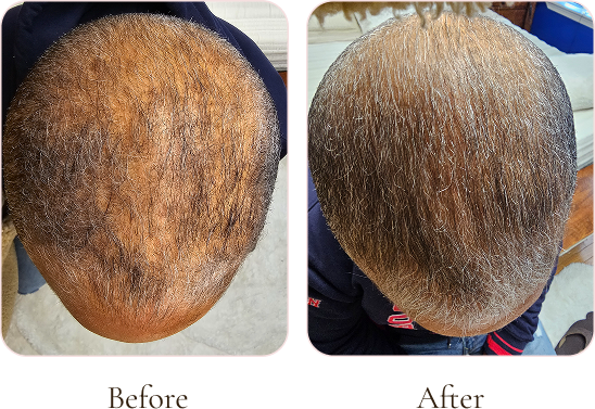 Comparison of a person's scalp before and after hair restoration treatment, showing increased hair density and coverage.