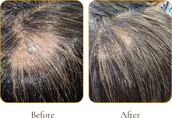 Close-up comparison of a person's scalp before and after hair treatment, showing increased hair density and health.
