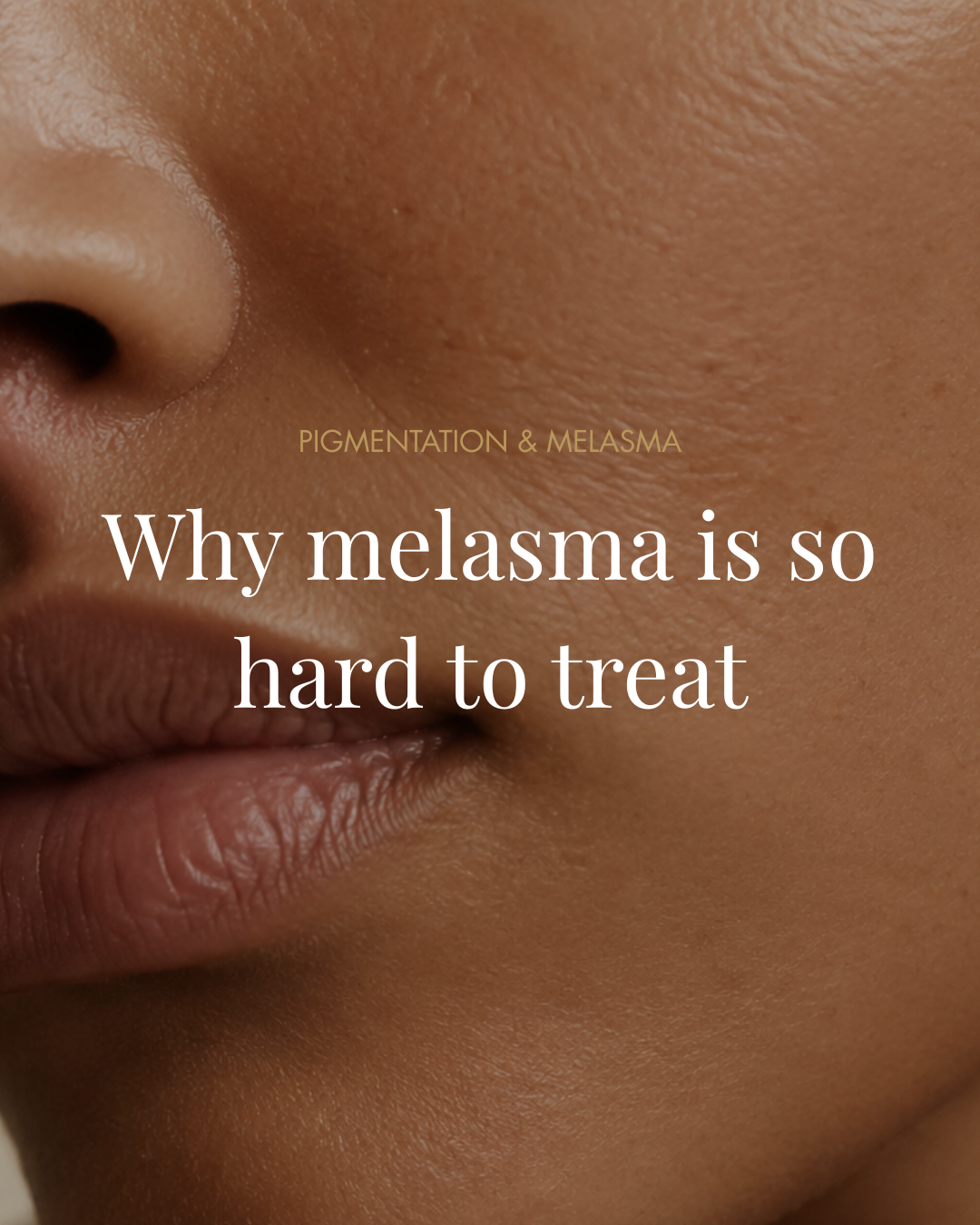 Why melasma is so hard to treat — and what actually fades it