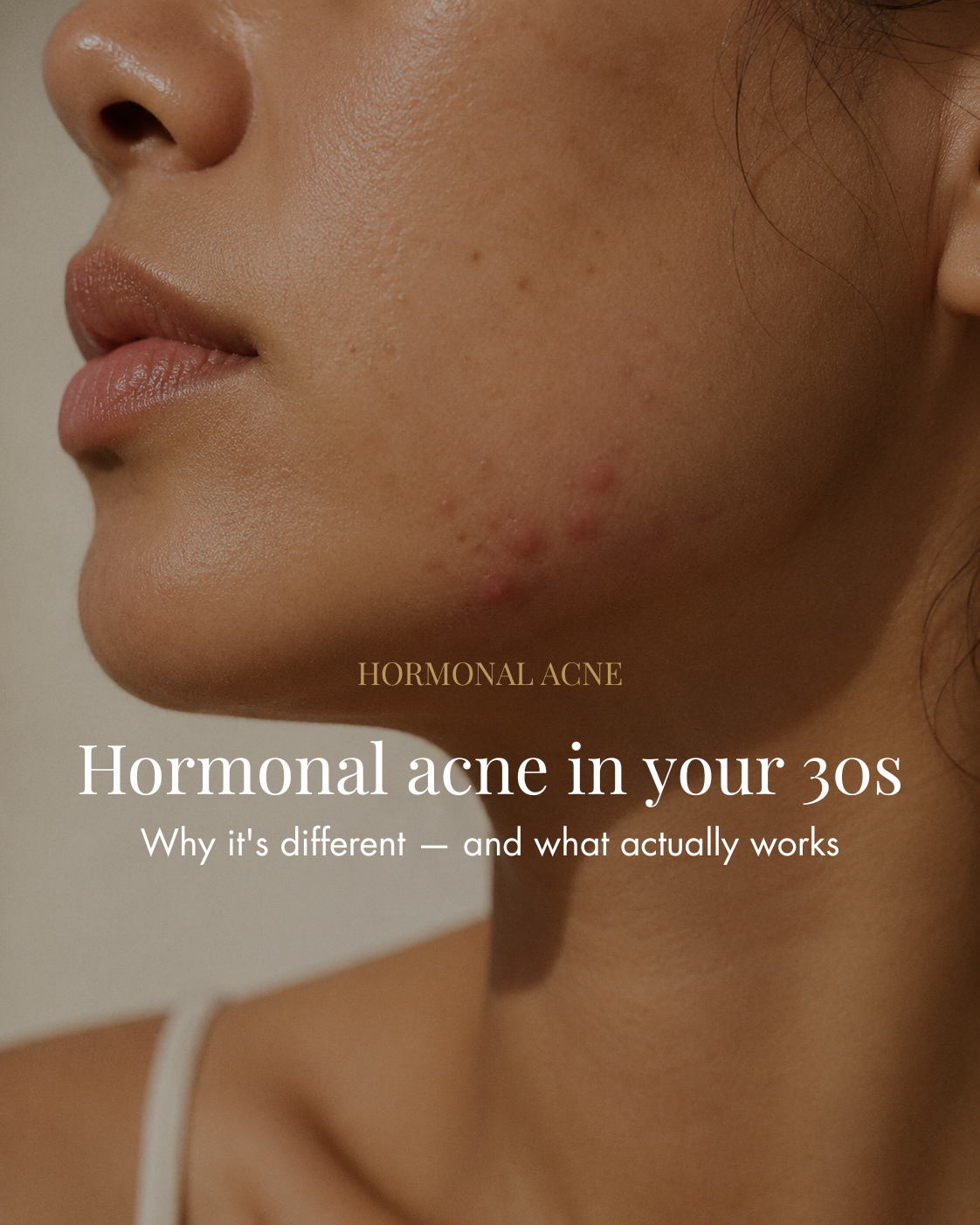 Hormonal acne in your 30s — why it's different and what actually works