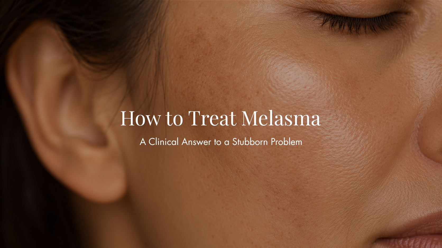 How to Treat Melasma: A Clinical Answer to a Stubborn Problem