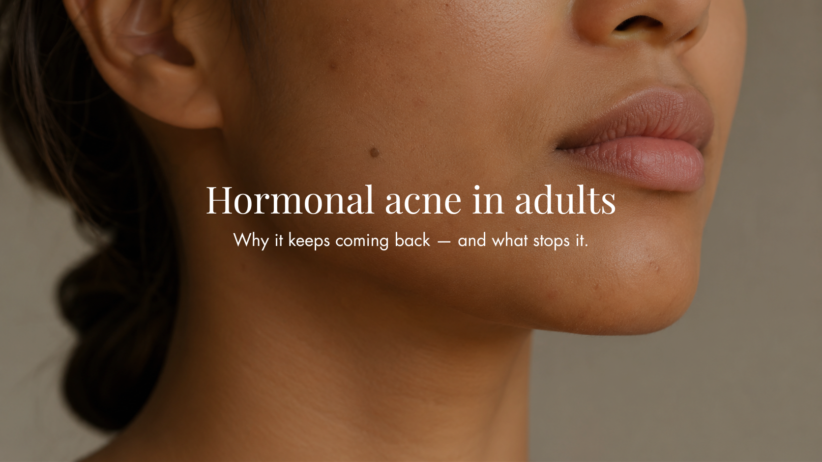 Hormonal Acne in Adults: Why It Keeps Coming Back and What Actually Stops It
