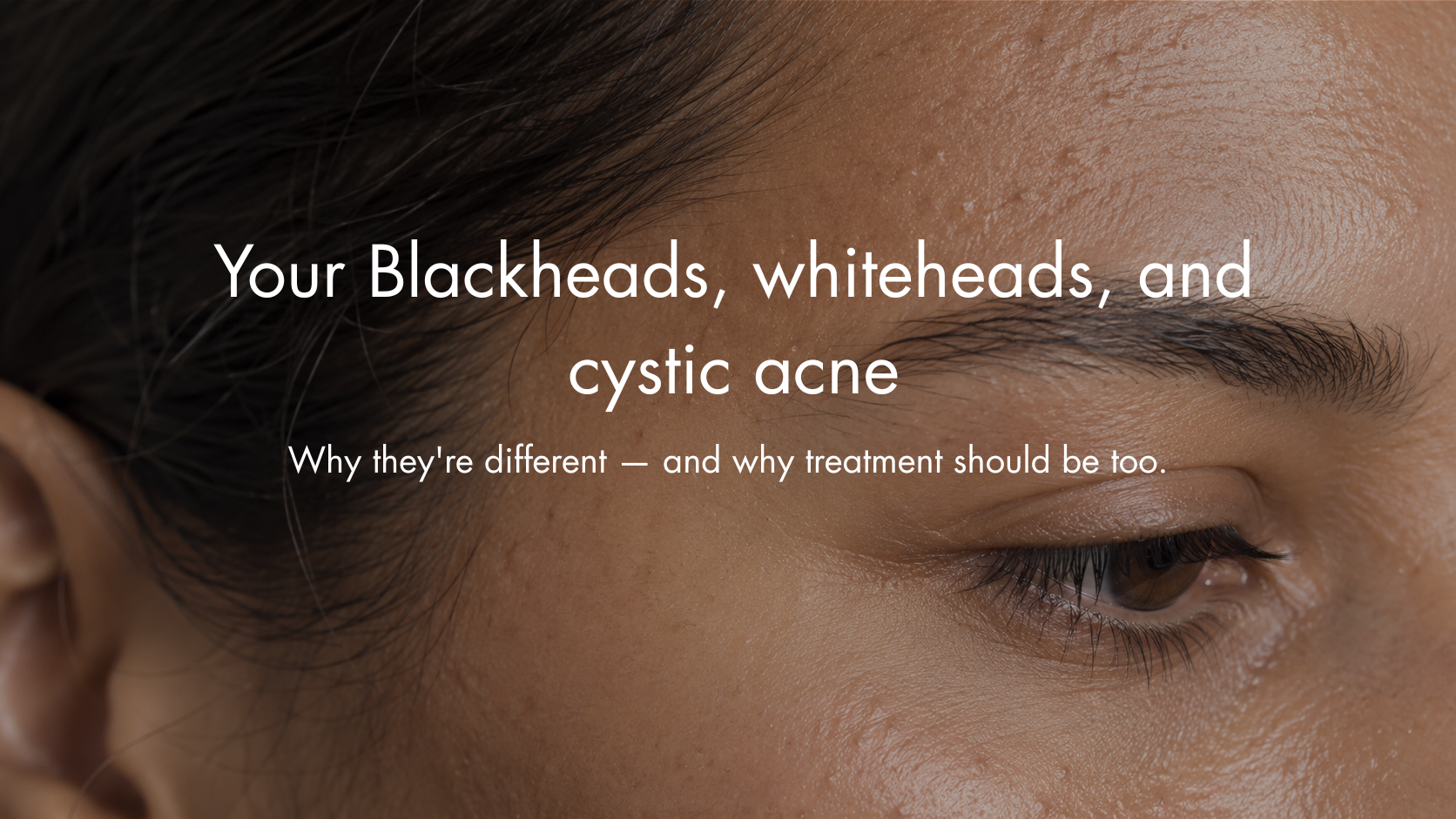 Blackheads, Whiteheads, and Cystic Acne: Why They're Different — and Why Treatment Should Be Too