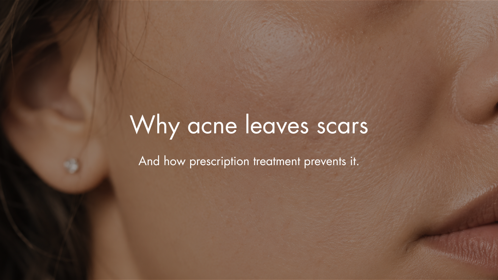 Why Acne Leaves Scars — and How Prescription Treatment Prevents It