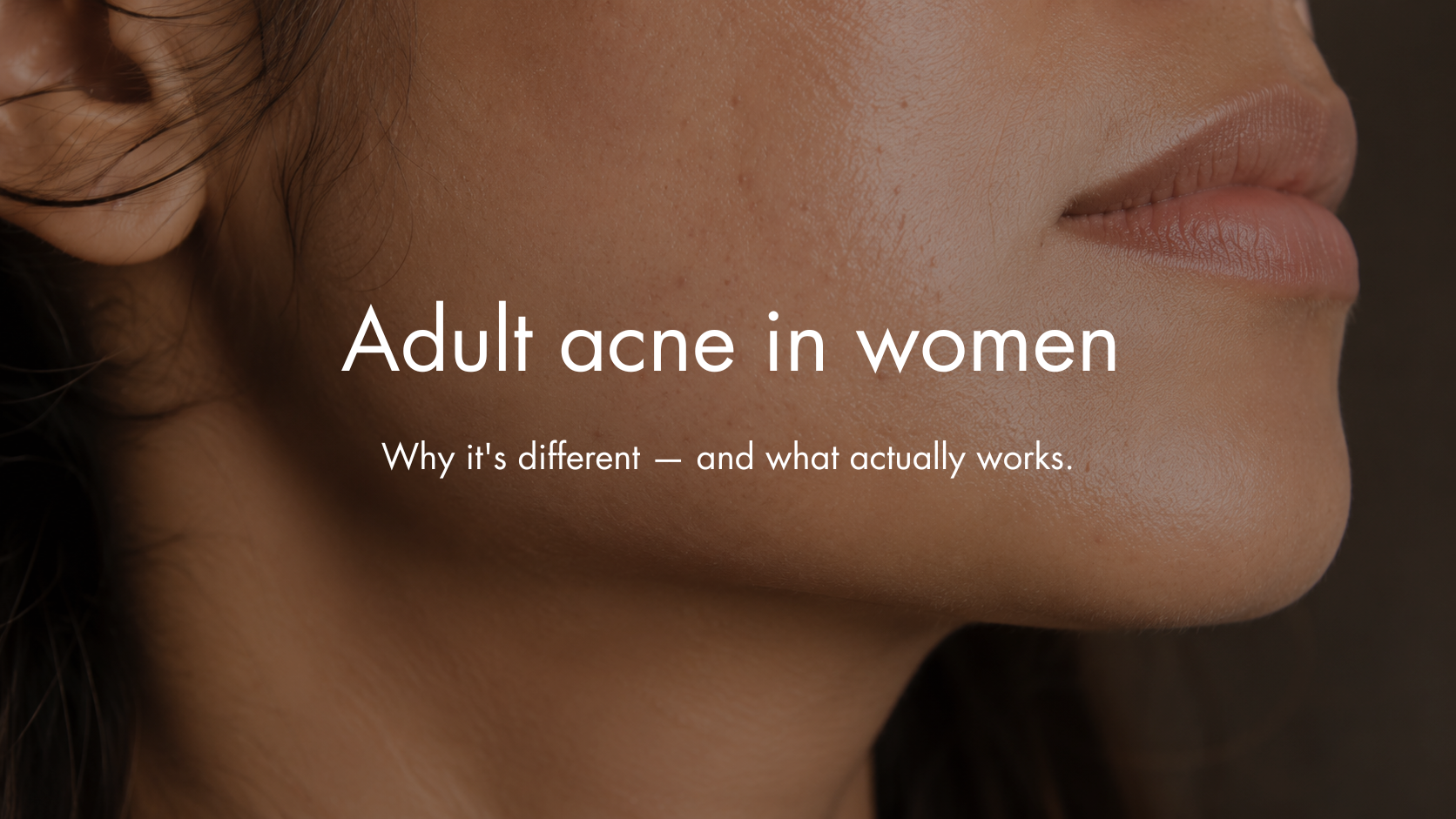 Adult Acne in Women: Why It's Different From Teenage Acne — and What Actually Works