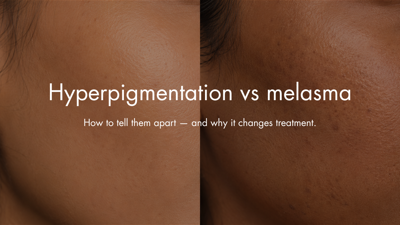 Hyperpigmentation vs Melasma: How to Tell the Difference — and Why It Changes Treatment