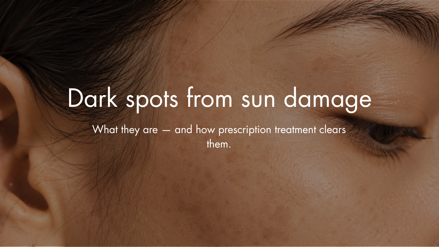 Dark Spots From Sun Damage: What They Are and How Prescription Treatment Clears Them