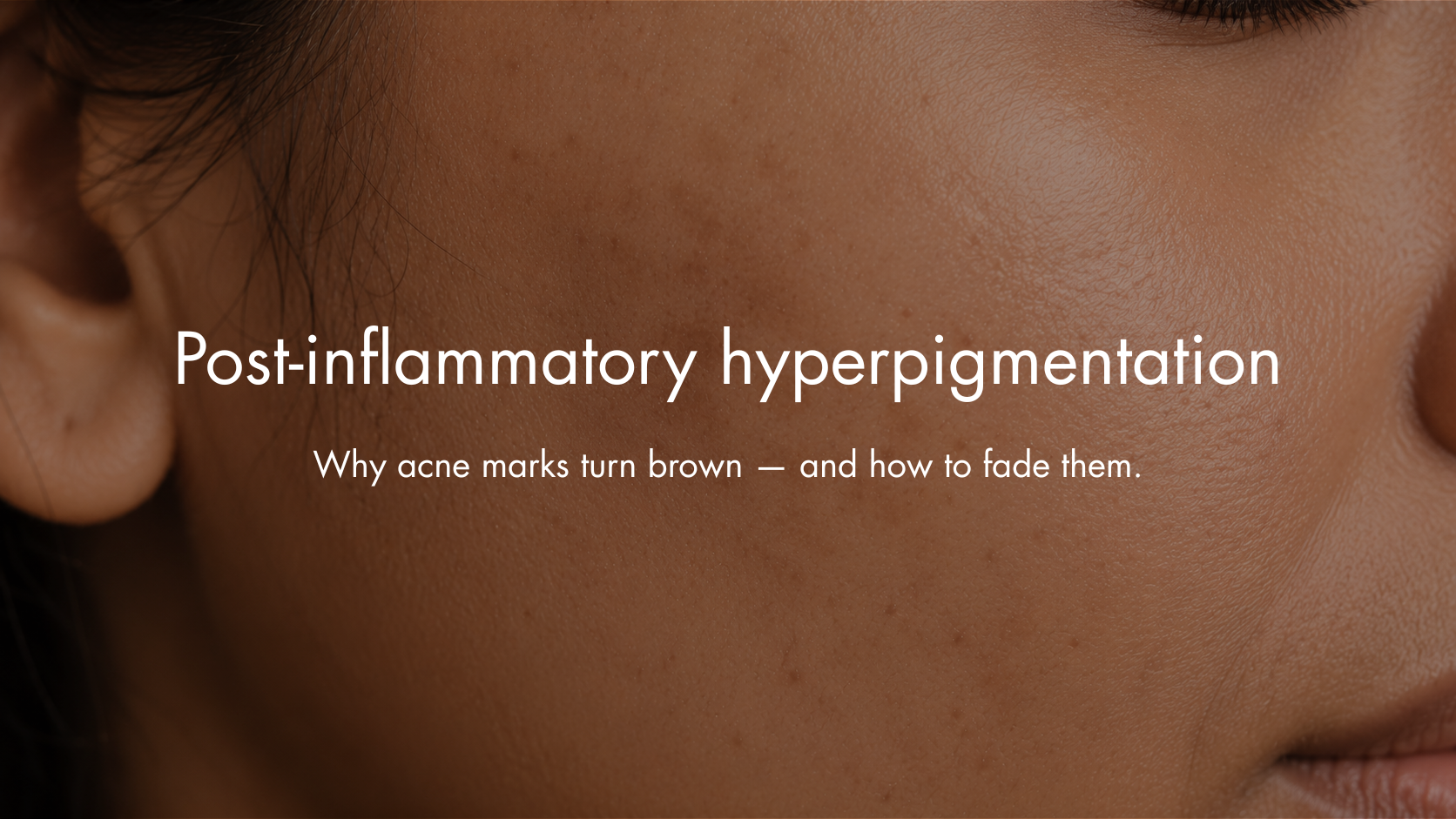 Post-Inflammatory Hyperpigmentation: Why Acne Marks Turn Brown — and How to Fade Them