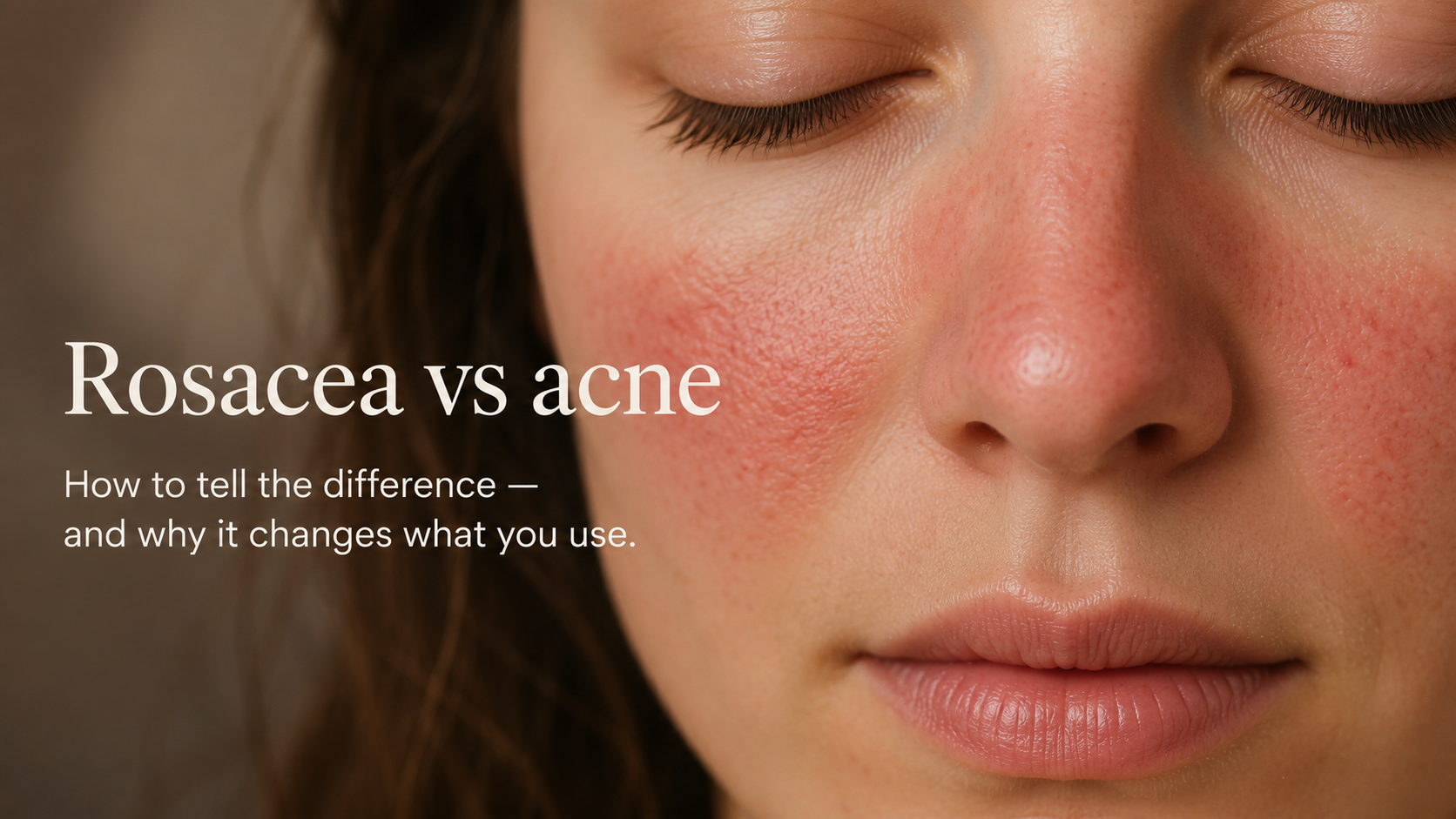 Rosacea vs Acne: How to Tell the Difference — and Why It Changes What You Should Use