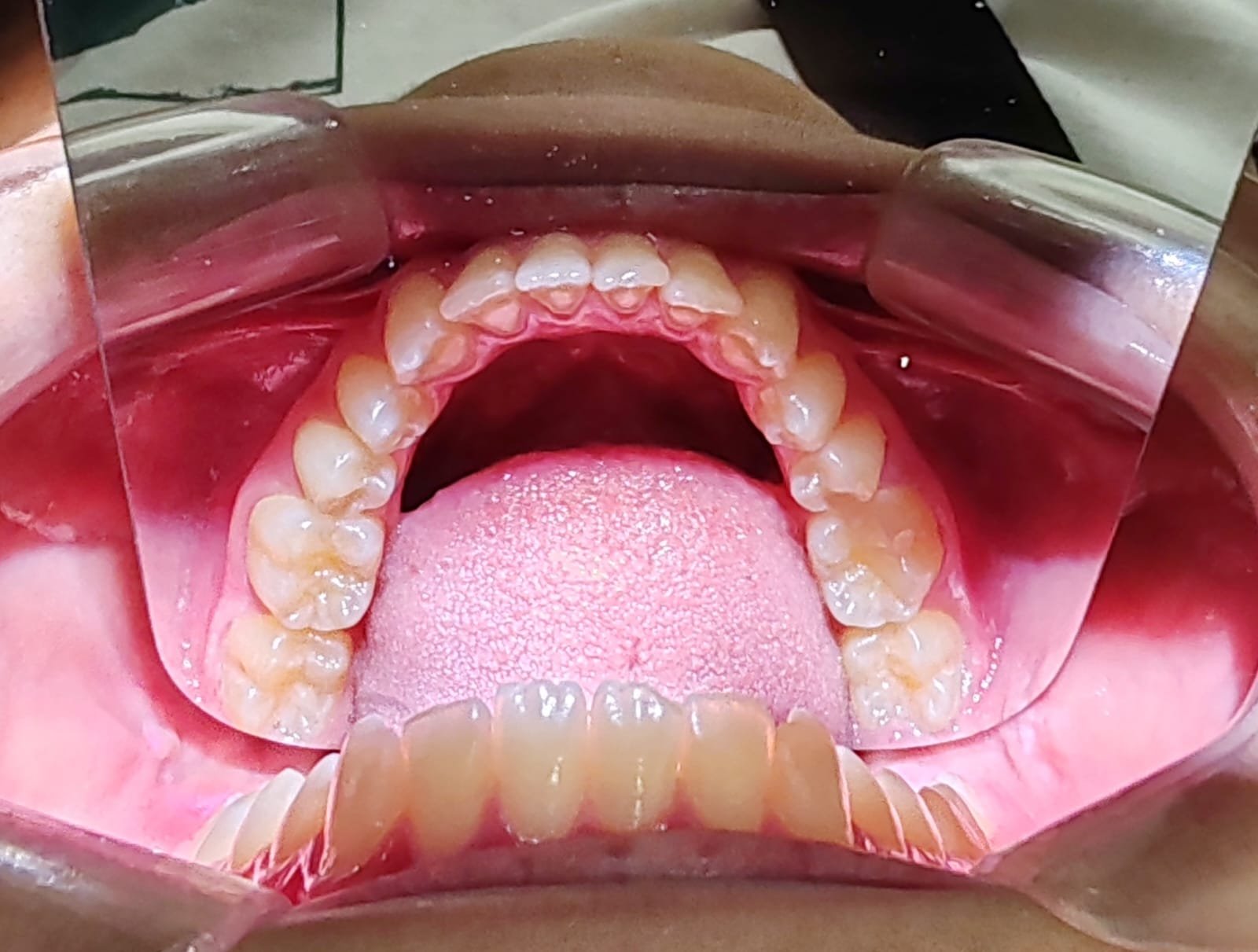 Close-up of the inside of a person's mouth showing the upper teeth, tongue, and palate.