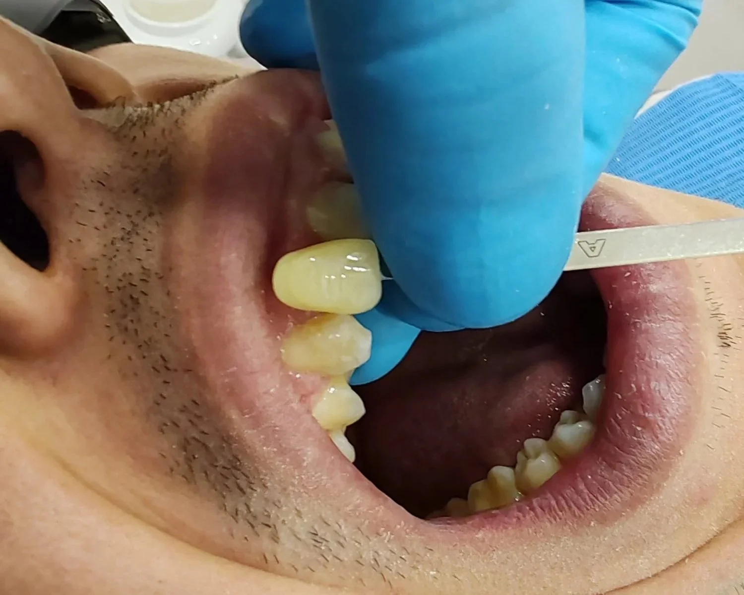 Close-up of tooth shade matching performed at Dental Playa.