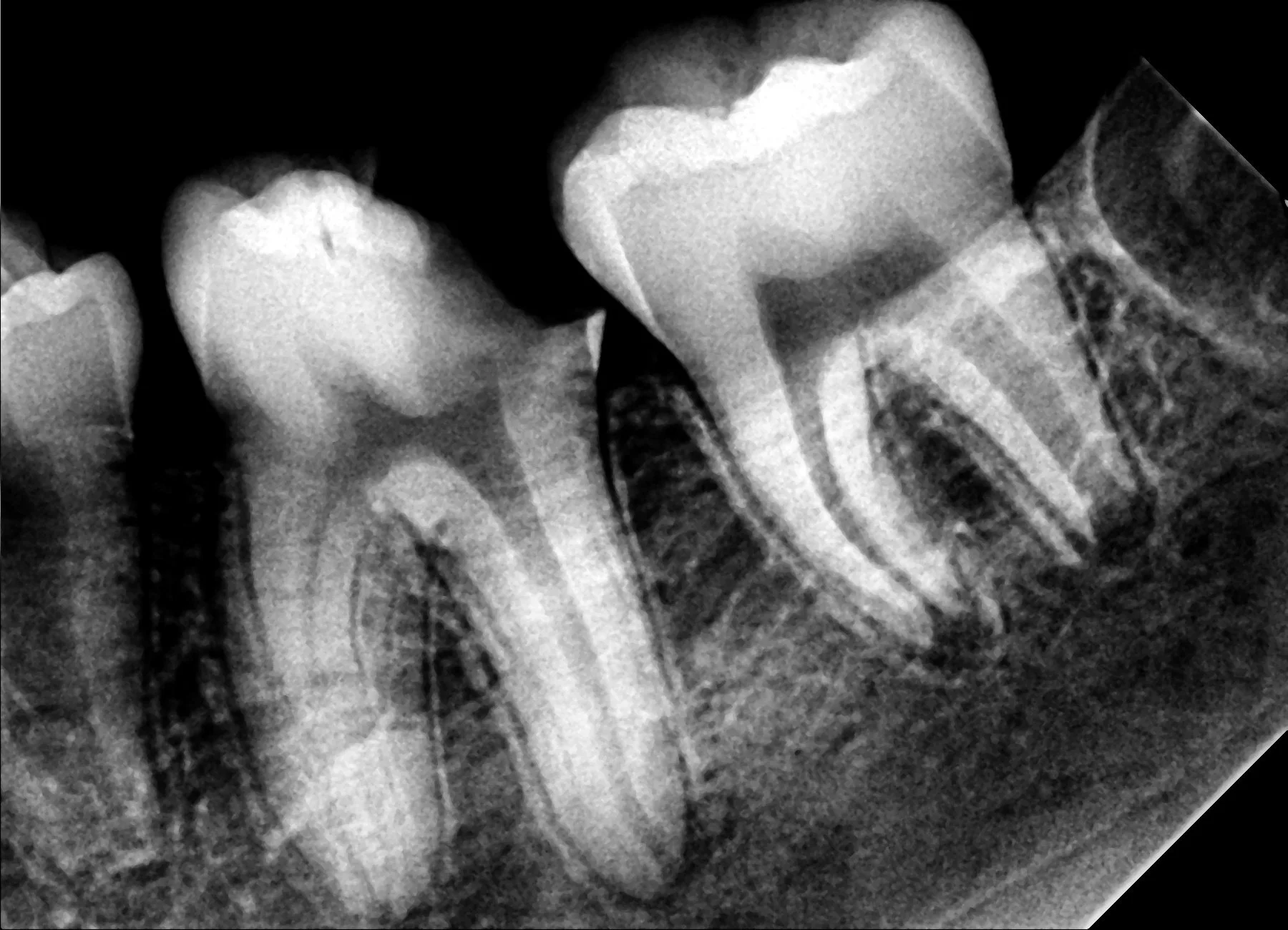 Dental X-ray at Dental Playa showing molar teeth with root canal treatment.