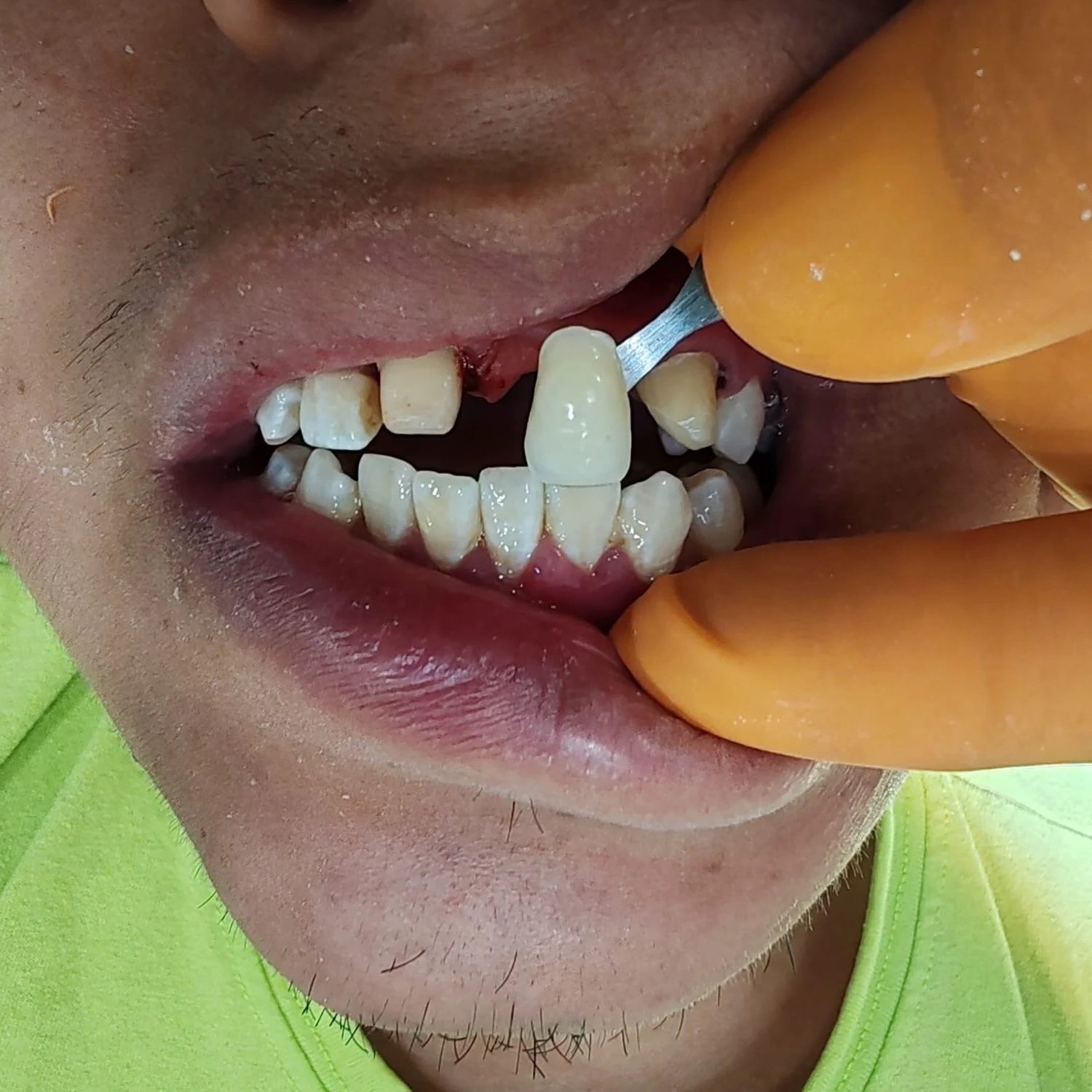 Missing tooth exam at Dental Playa in Playa del Carmen.