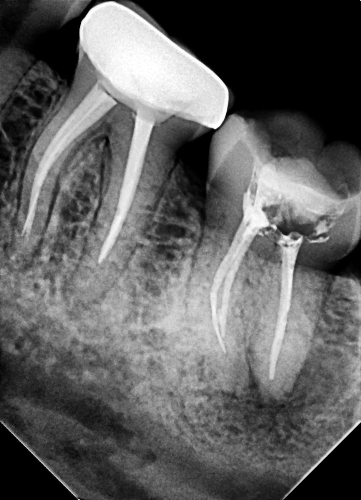 Black and white dental X-ray showing three root canal-treated teeth with fillings.