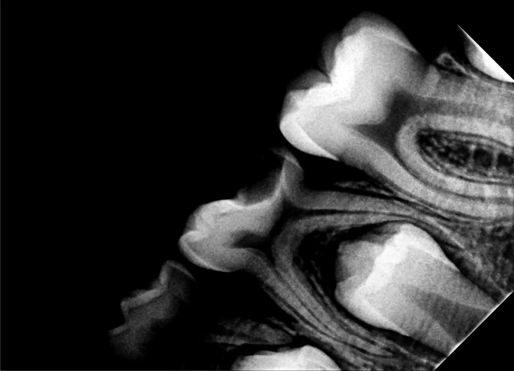 Black and white X-ray image of a molar.