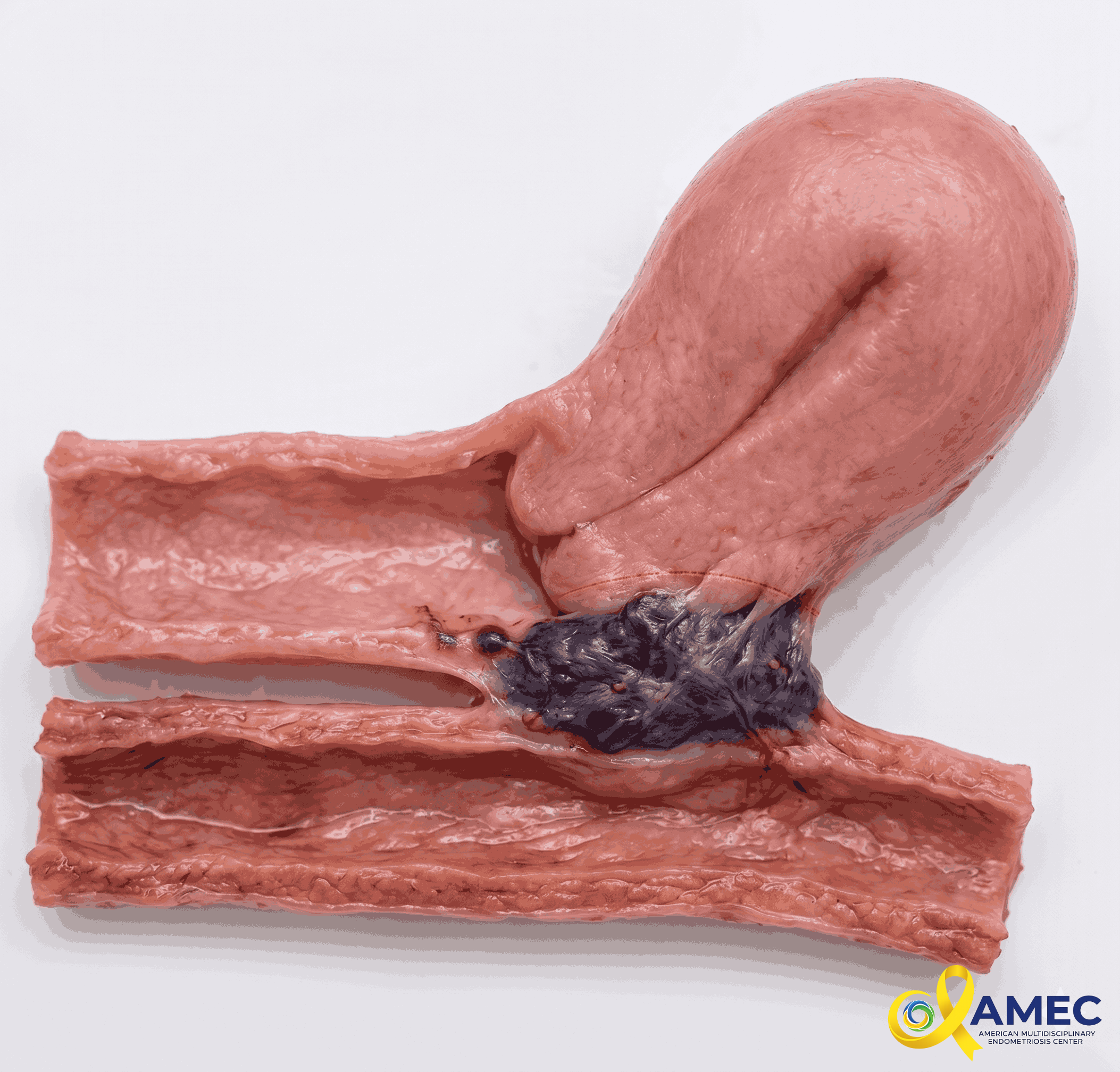 an endometriosis nodule between the cervix and the rectum