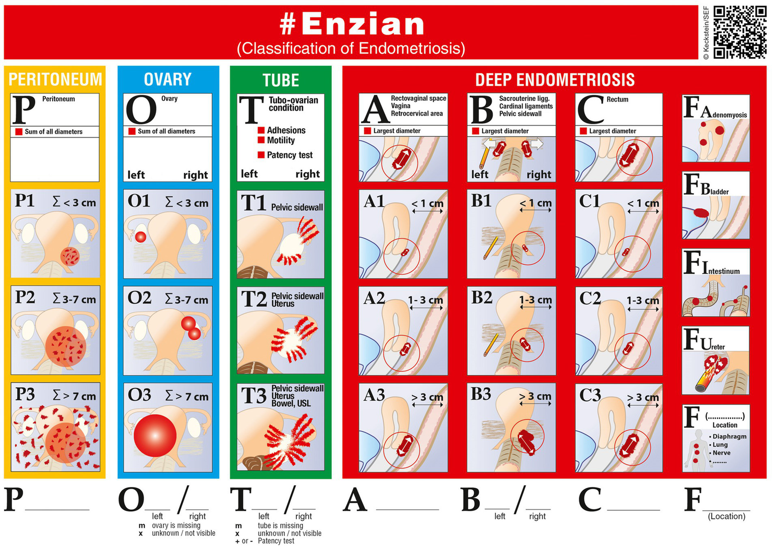 Endometriosis Classifications