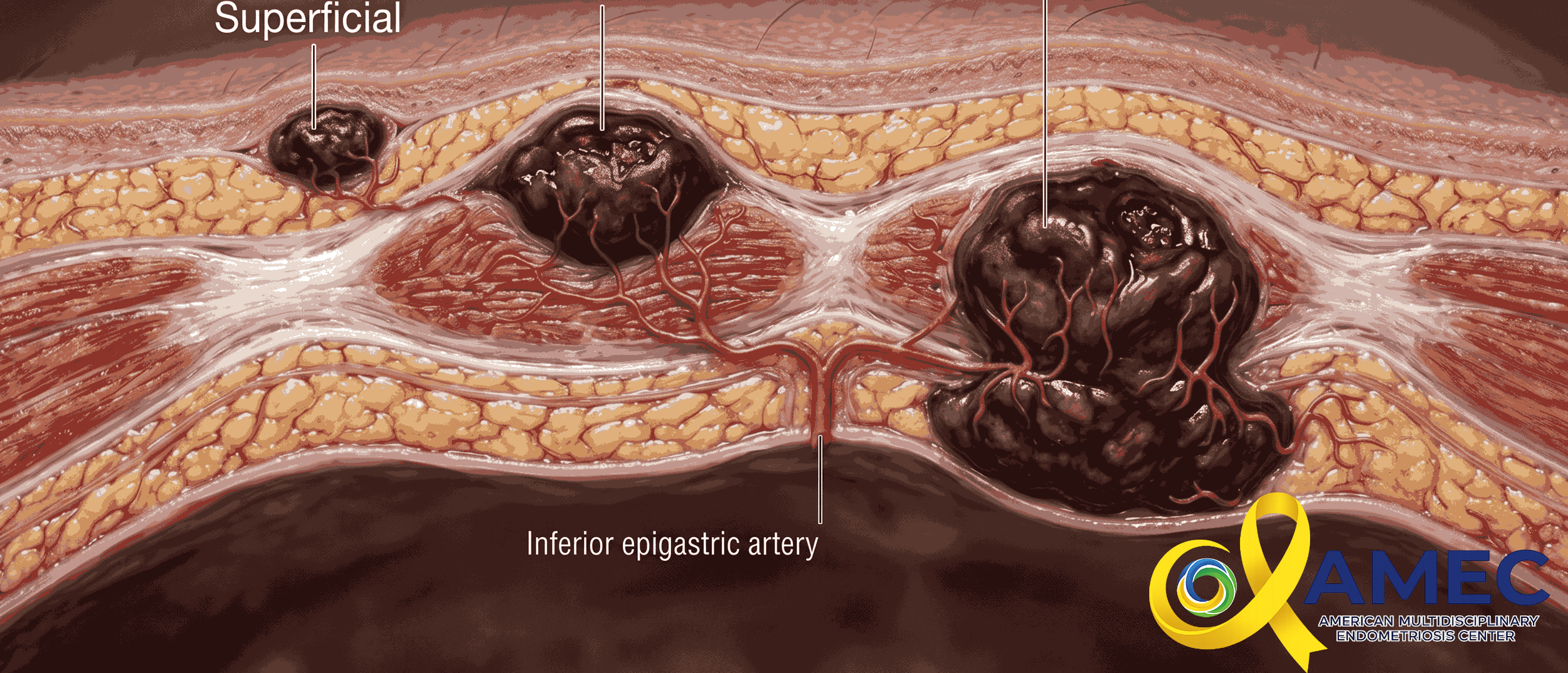 different types of abdominal wall endometriomas