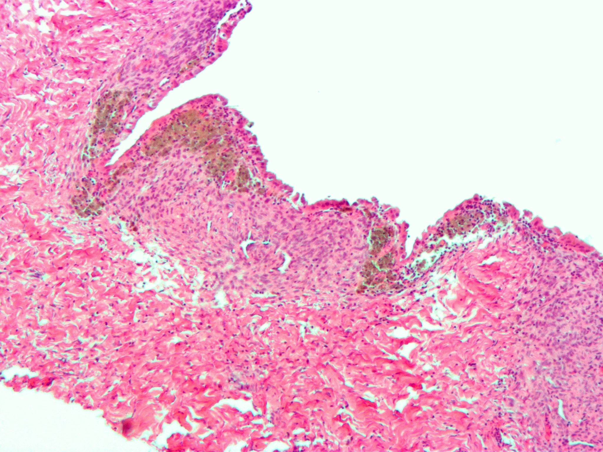 Histology of endometriosis lesions show stroma and gland similar to the endometrium