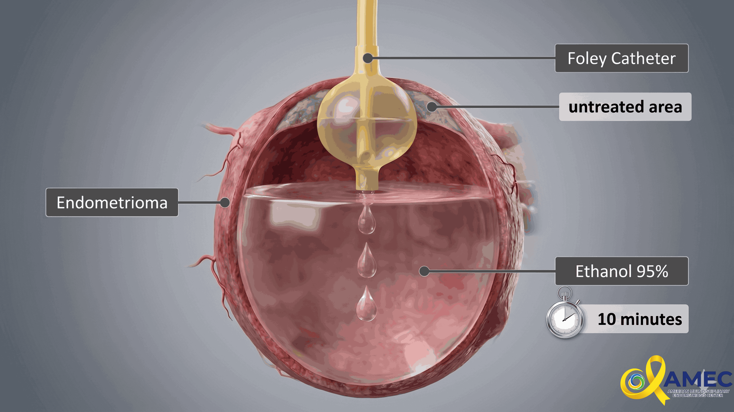 alcohol and foley catheter used in sclerotherapy