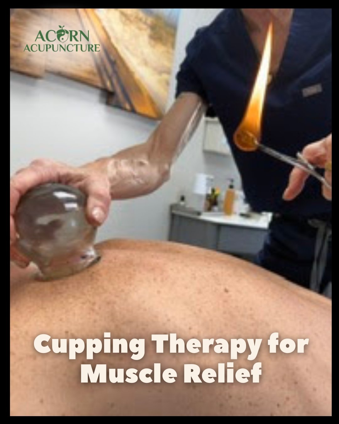 Cupping therapy is a traditional technique often used to help support muscle recovery, relaxation, and overall wellness. 

Many patients enjoy cupping as part of their wellness routine to help ease tension, promote circulation, and encourage relaxati