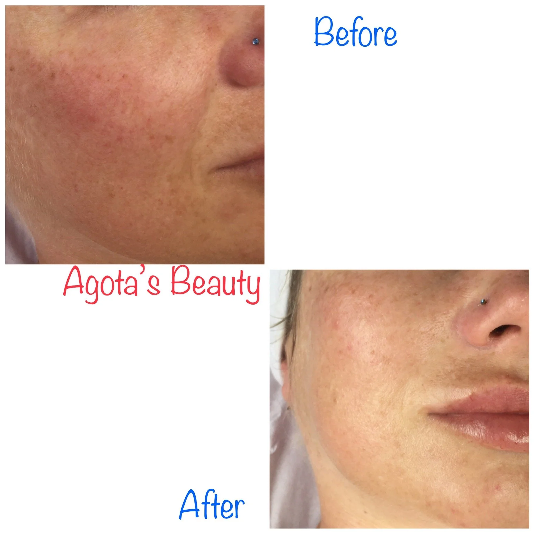 Redness Reduction & Clearer Skin | Before & After Facial Results