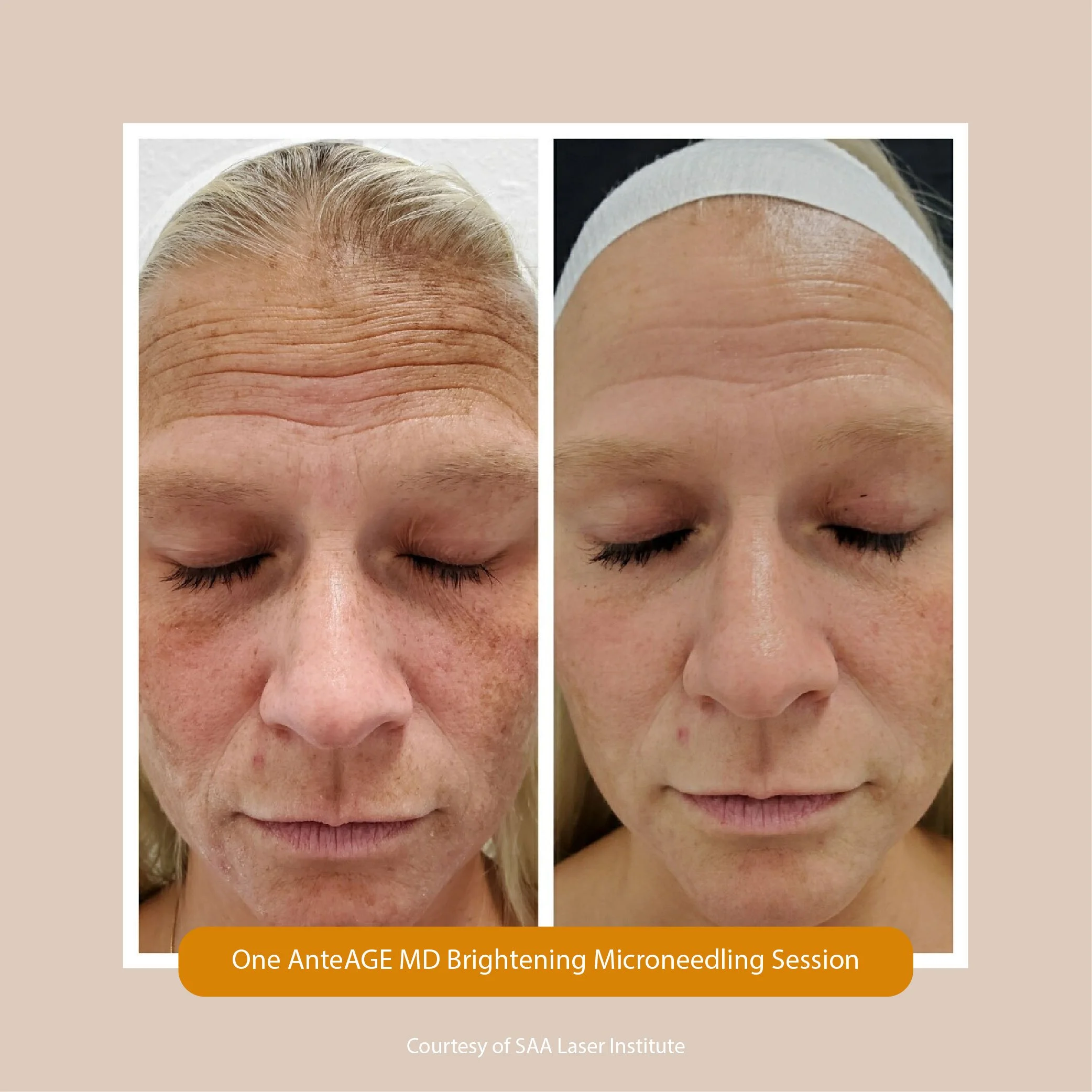 Before and after images showcasing the results of a microneedling skin treatment. The left side displays an aged, wrinkled forehead with visible lines and skin imperfections. The right side shows a smoother, more youthful forehead with fewer wrinkles and improved skin texture.
