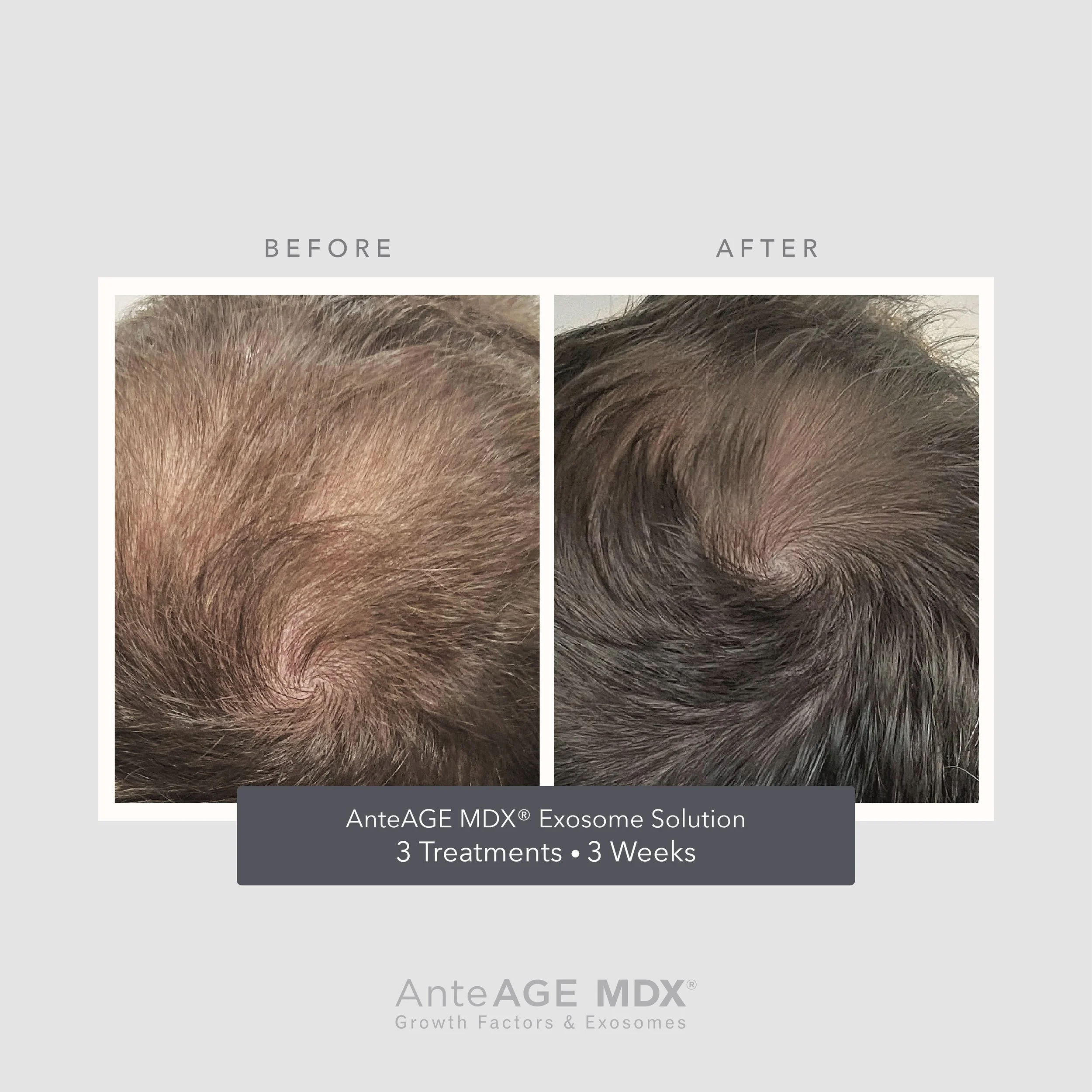 Comparison of before and after hair growth on the top of a person's head, showing improved hair density after three treatments over three weeks.