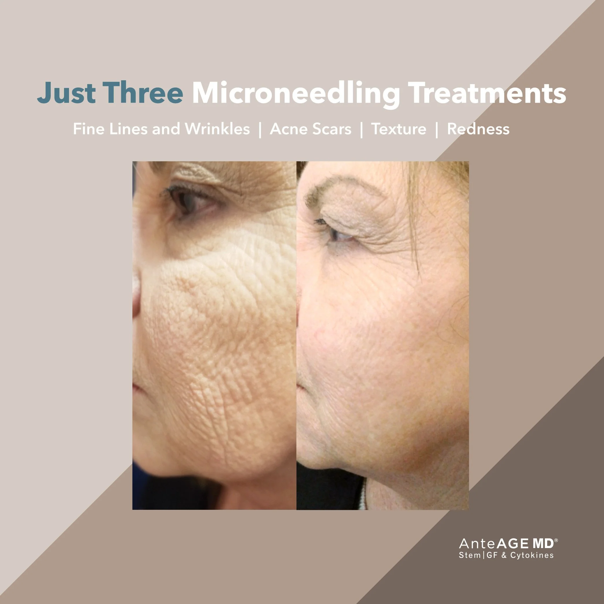 Close-up of a person's eye area before and after microneedling treatment showing reduction in fine lines and wrinkles.