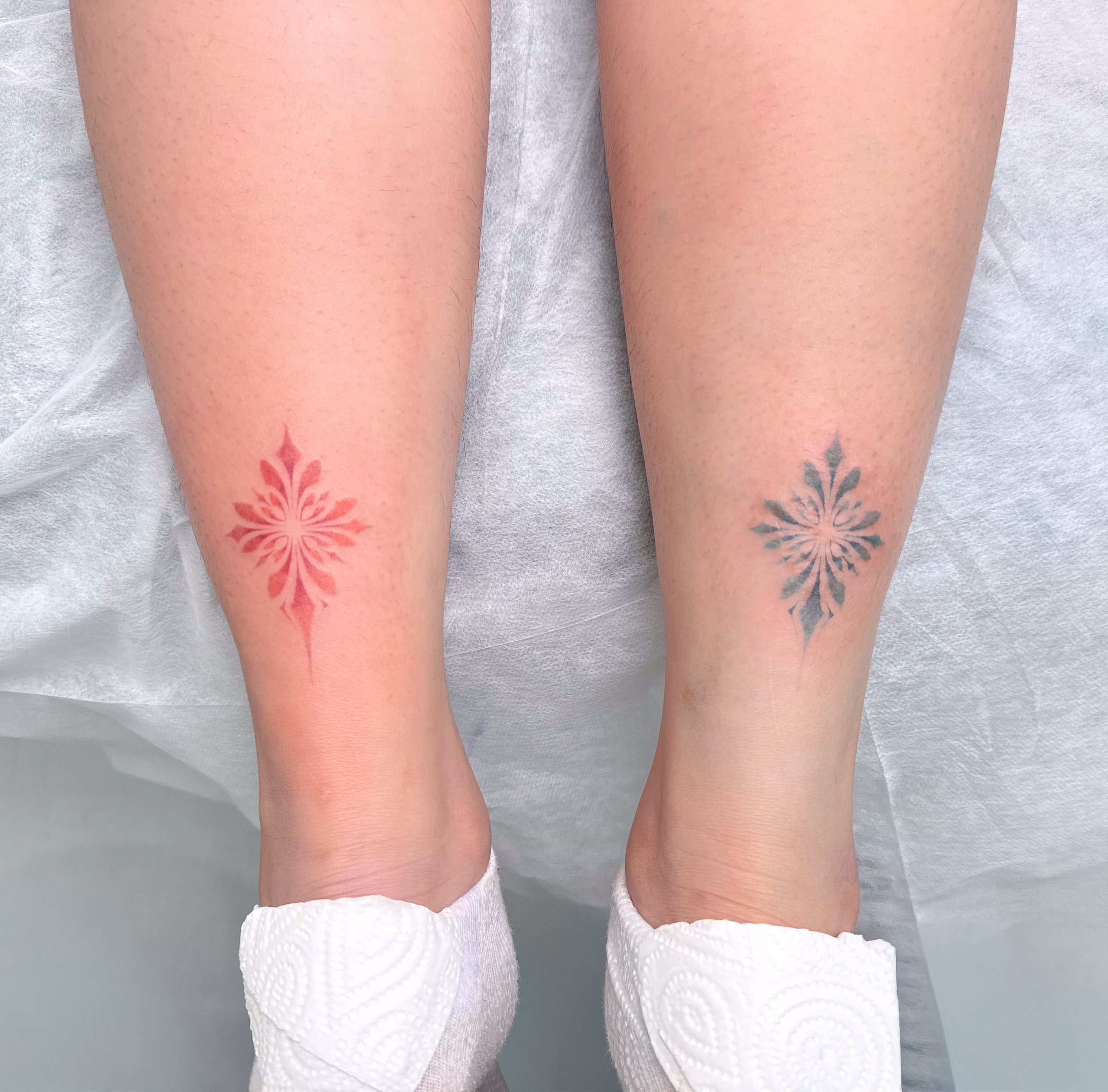 รอยสักคู่สไตล์ Fine Line สำหรับปกปิดรอยแผลเป็นจาก Let’s Tatt Studio / Fine line scar cover up tattoo by Let’s Tatt Studio Chiang Mai