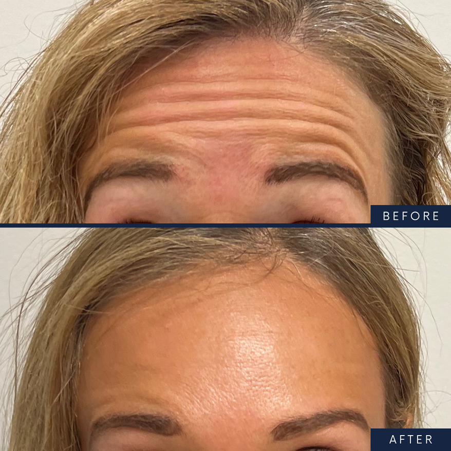 Forehead Botox Injection Service