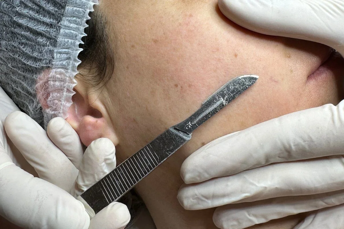 Close-up of a person receiving a dermatological treatment, with a practitioner using a small scalpel on their skin near the ear. The person is wearing a hair covering and gloves.