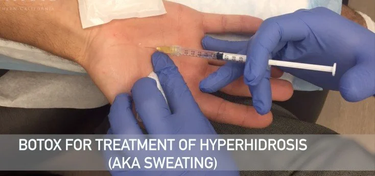 A person receiving a Botox injection in their hand for hyperhidrosis (sweating) treatment, with a medical professional wearing blue gloves administering the injection.