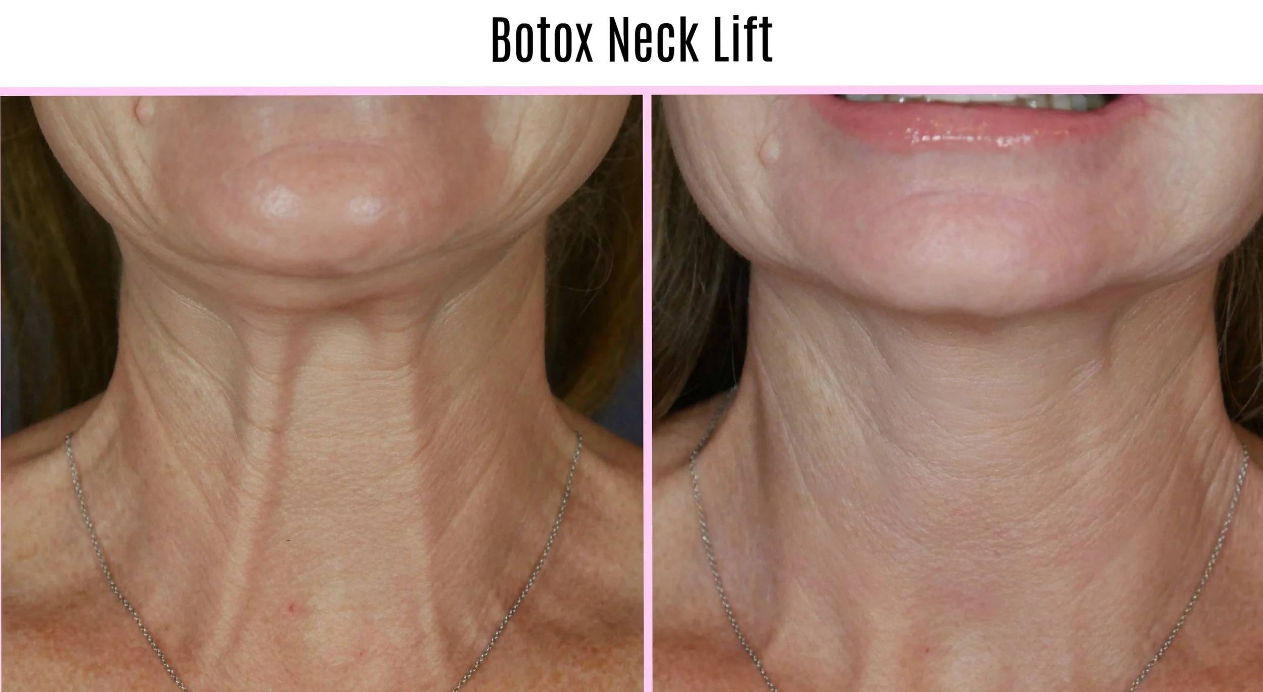 Side-by-side before and after images of a woman's neck, showing the effects of Botox neck lift treatment with reduced wrinkles and smoother skin.