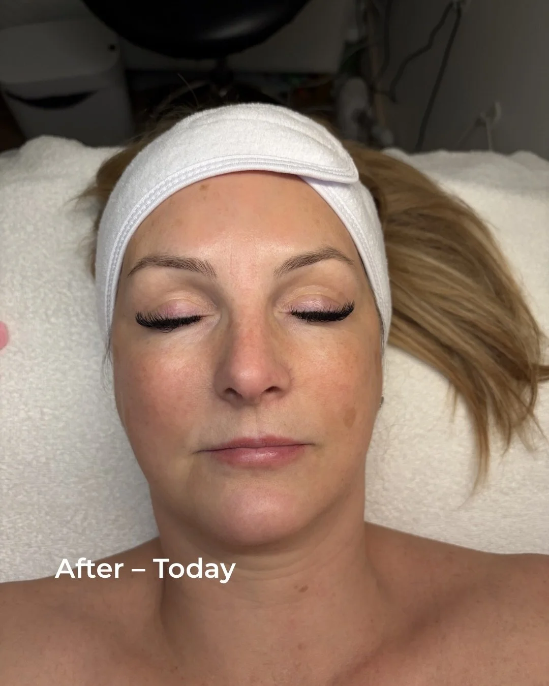 Real skin progress from consistency ✨

Before photo: January (client photo taken at home)
After photo: Today in clinic.

Treatment plan used for this client:

&bull; Dermaplaning treatments
&bull; 2 Vivier Professional Peels
&bull; Treatments perform