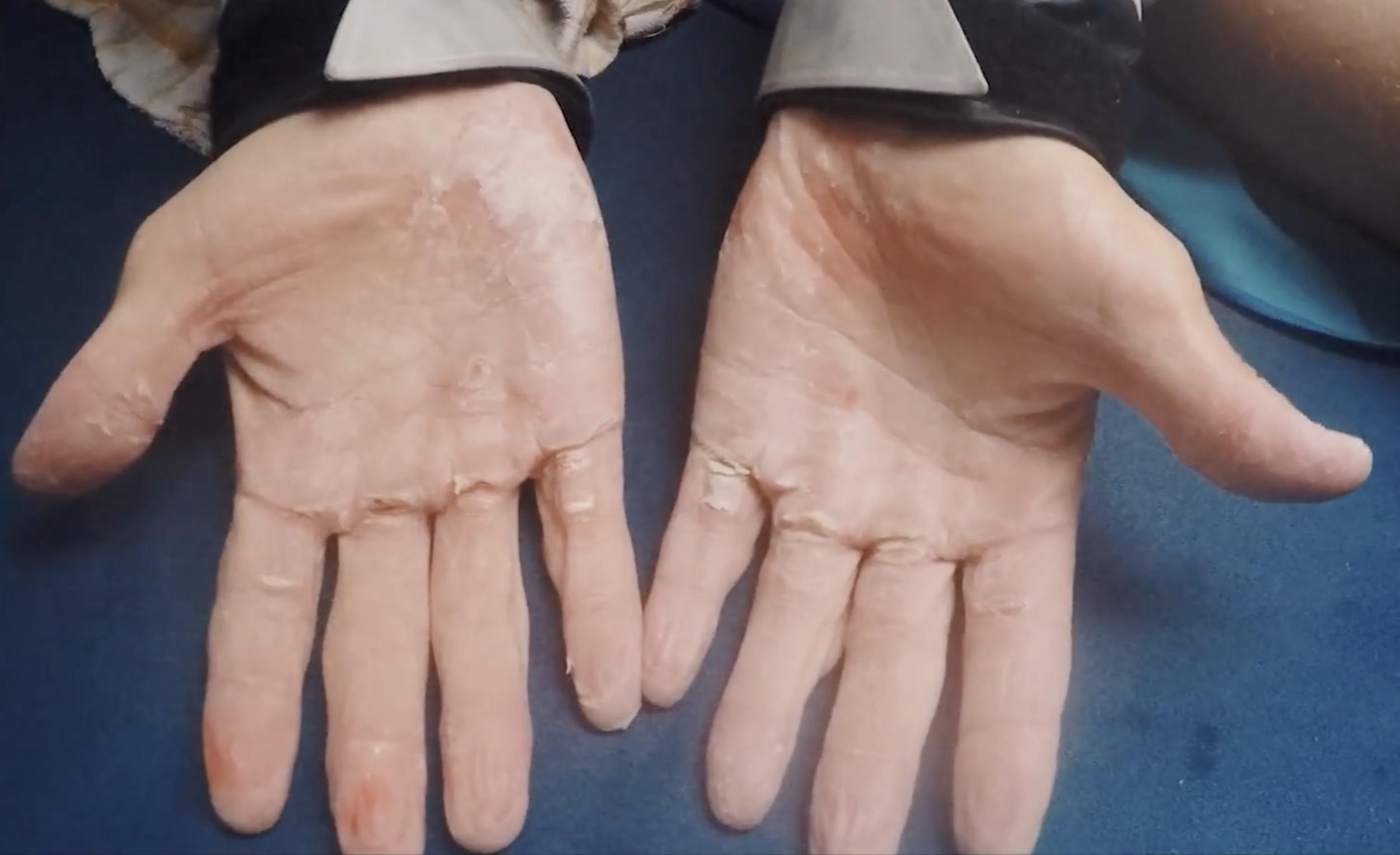 A pair of hands with dry, peeling skin resting on a dark blue surface.