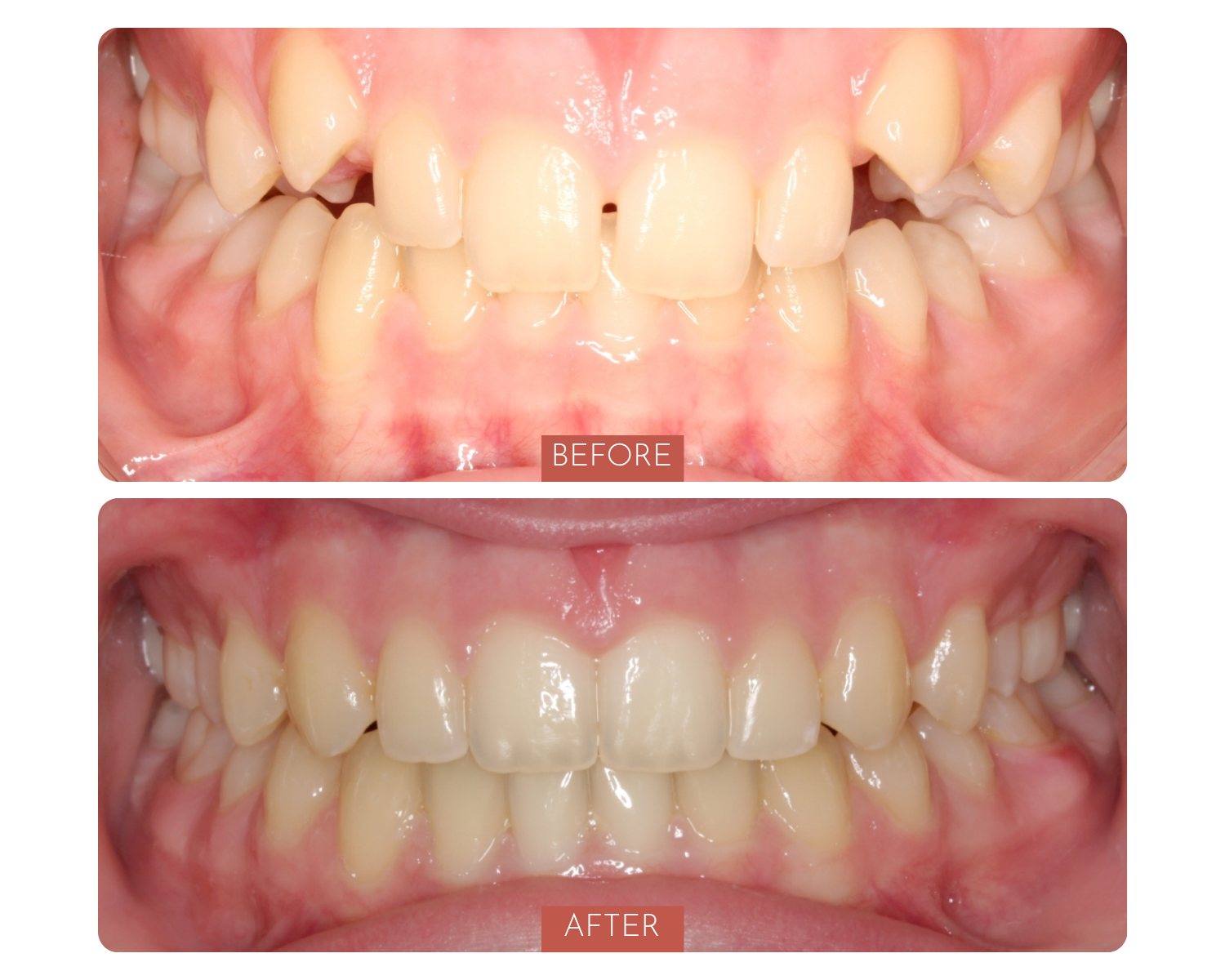 Comparison of teeth before and after dental treatment; the 'before' image shows crooked and crowded teeth, while the 'after' image shows straighter, more aligned teeth.