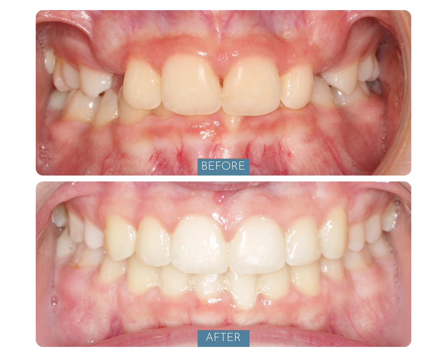 Comparison of teeth before and after dental treatment, showing improved alignment and appearance.