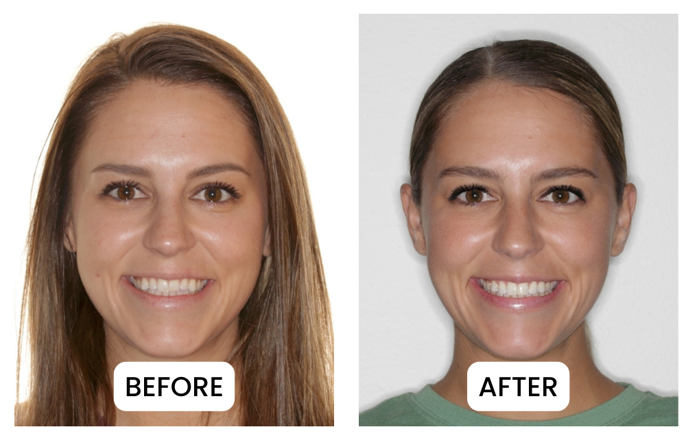 Before and after a smile arc treatment on a woman