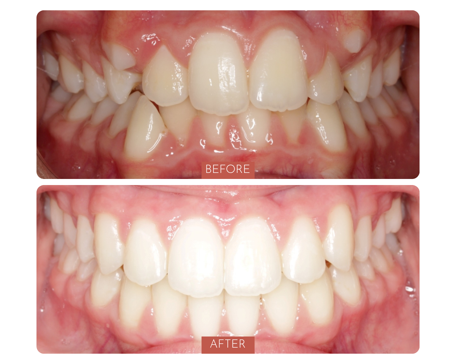Comparison of teeth before and after dental treatment, showing improved alignment and appearance.