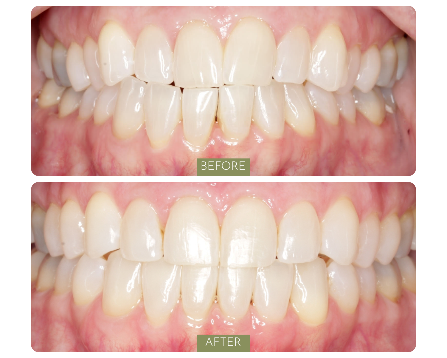 Comparison of teeth before and after dental whitening treatment, showing visibly whiter teeth in the after image.